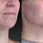 Chin Filler Before and After Photos in Montvale, NJ, Patient 21103
