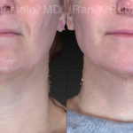Chin Filler Before and After Photos in Montvale, NJ, Patient 21103