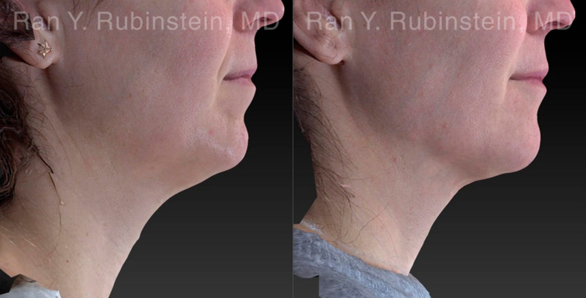 Chin Filler Before and After Photos in Montvale, NJ, Patient 21103