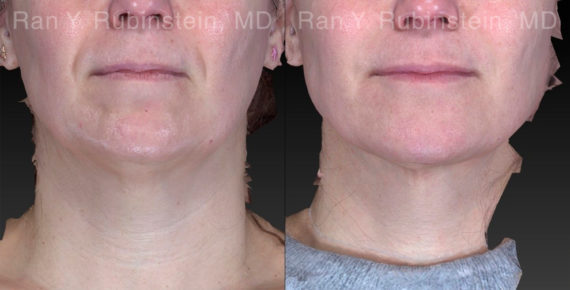 Chin Filler Before and After Photos in Montvale, NJ, Patient 21103