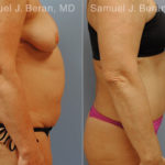 Abdominoplasty Before and After Photos in Montvale, NJ, Patient 12246