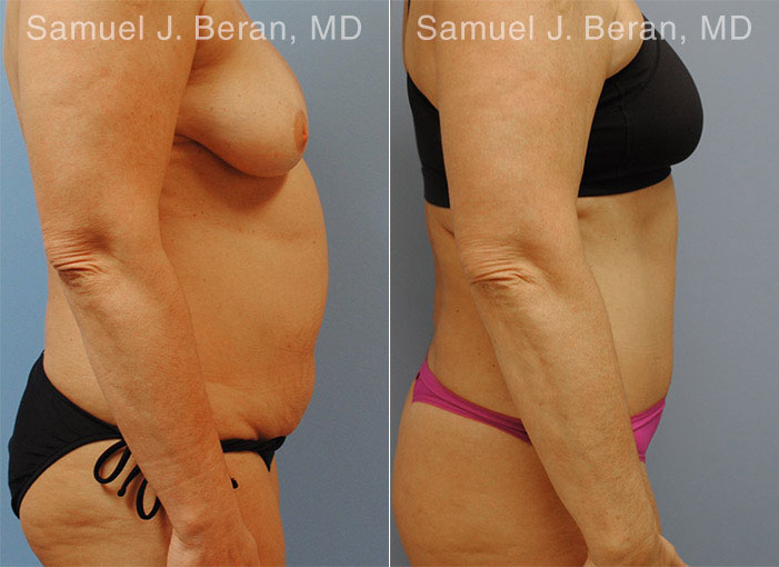 Abdominoplasty Before and After Photos in Montvale, NJ, Patient 12246
