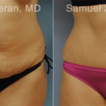 Abdominoplasty Before and After Photos in Montvale, NJ, Patient 12246