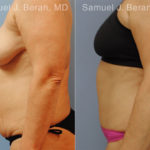 Abdominoplasty Before and After Photos in Montvale, NJ, Patient 12246