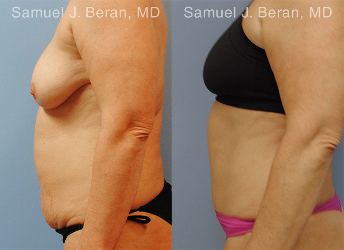 Abdominoplasty Before and After Photos in Montvale, NJ, Patient 12246