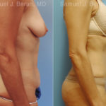 Abdominoplasty Before and After Photos in Montvale, NJ, Patient 12253