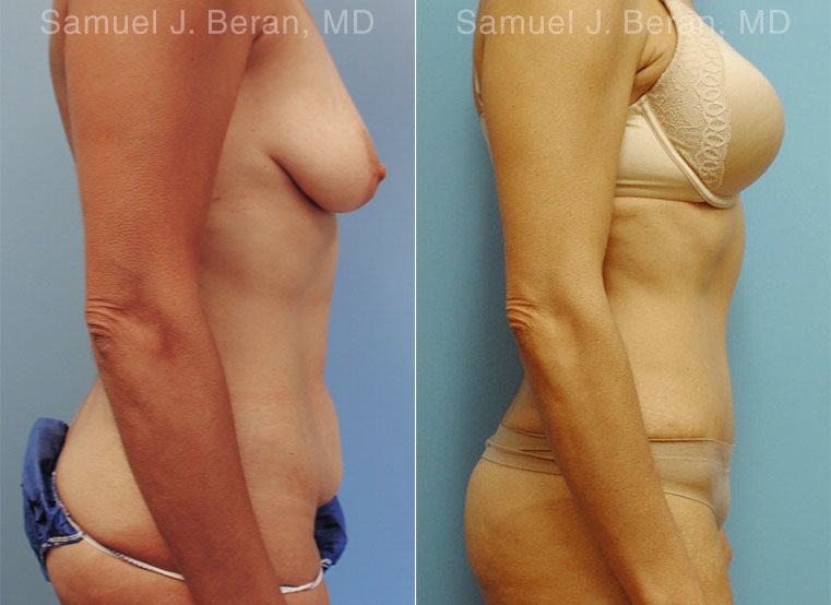 Abdominoplasty Before and After Photos in Montvale, NJ, Patient 12253