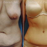 Abdominoplasty Before and After Photos in Montvale, NJ, Patient 12253