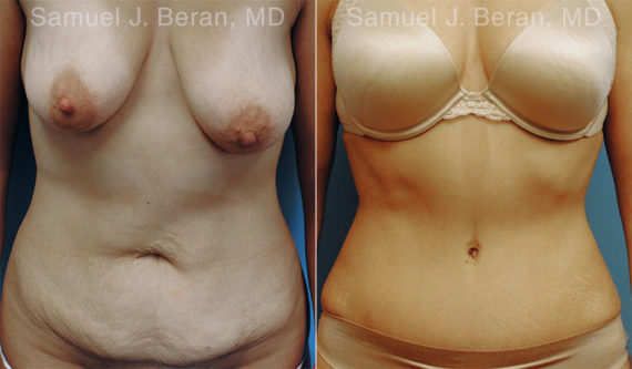 Abdominoplasty Before and After Photos in Montvale, NJ, Patient 12253