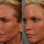 Botox Before and After Photos in Montvale, NJ, Patient 12271