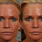 Botox Before and After Photos in Montvale, NJ, Patient 12271