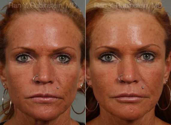 Botox Before and After Photos in Montvale, NJ, Patient 12271