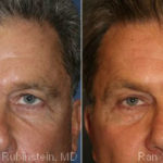Botox Before and After Photos in Montvale, NJ, Patient 12276