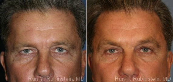 Botox Before and After Photos in Montvale, NJ, Patient 12276