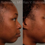 Chin Augmentation Before and After Photos in Montvale, NJ, Patient 12384