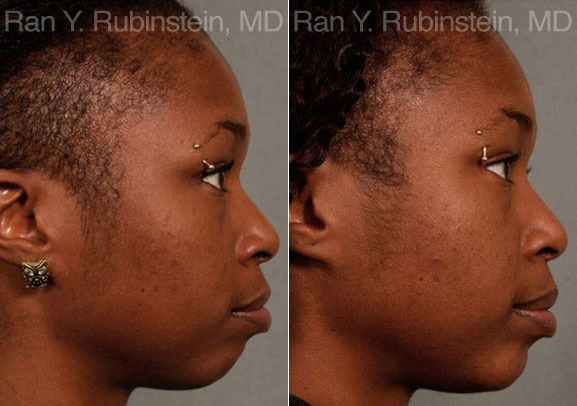 Chin Augmentation Before and After Photos in Montvale, NJ, Patient 12384