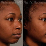 Chin Augmentation Before and After Photos in Montvale, NJ, Patient 12384