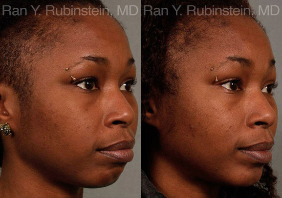 Chin Augmentation Before and After Photos in Montvale, NJ, Patient 12384
