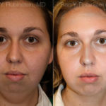 Chin Augmentation Before and After Photos in Montvale, NJ, Patient 12389