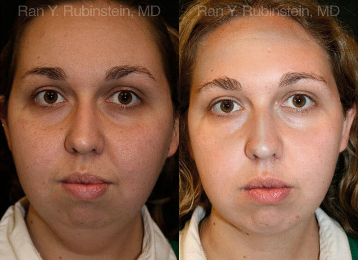 Chin Augmentation Before and After Photos in Montvale, NJ, Patient 12389
