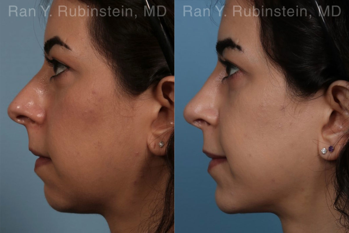 Chin Augmentation Before and After Photos in Montvale, NJ, Patient 12394