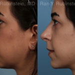 Chin Augmentation Before and After Photos in Montvale, NJ, Patient 12394