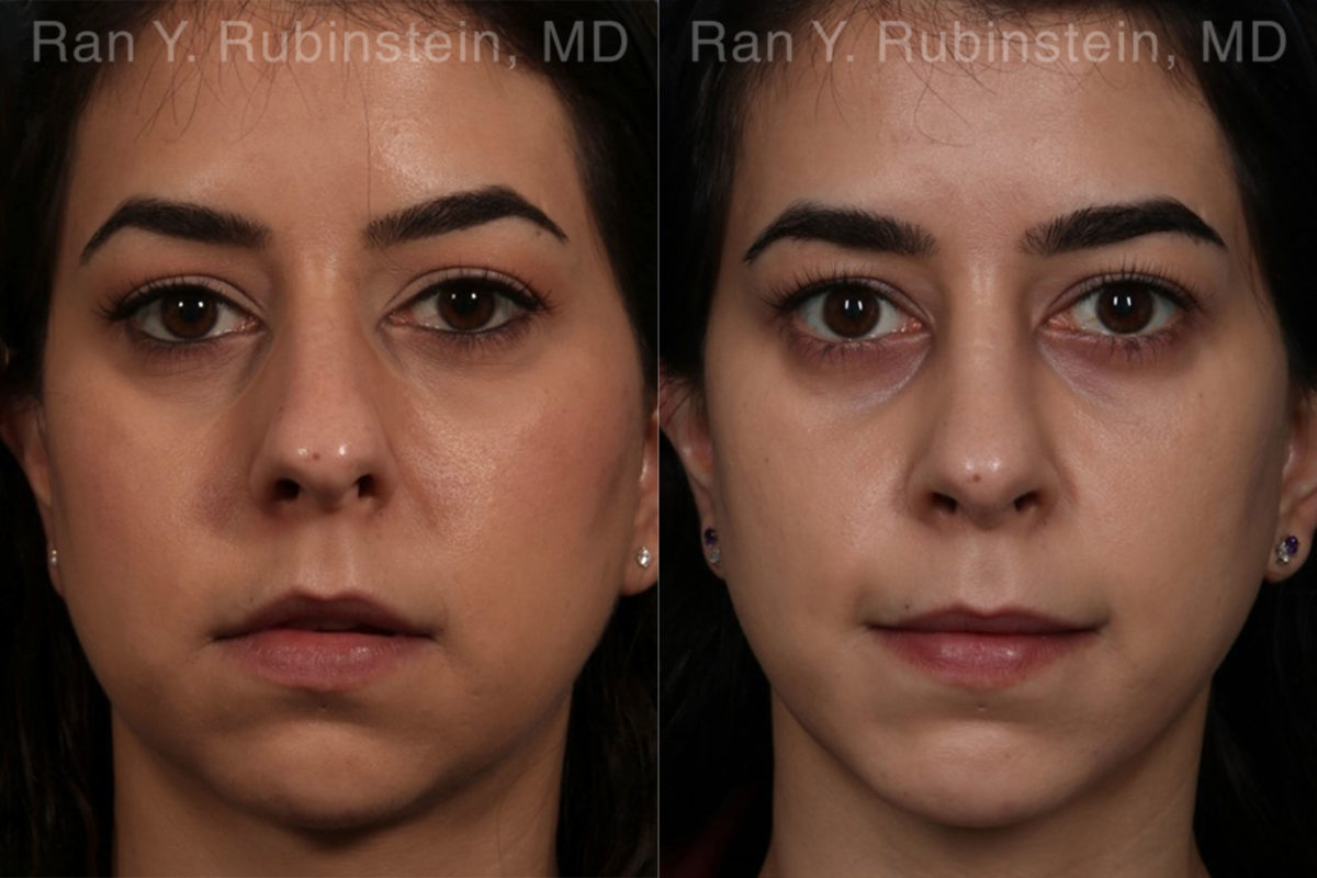 Chin Augmentation Before and After Photos in Montvale, NJ, Patient 12394
