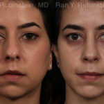 Chin Augmentation Before and After Photos in Montvale, NJ, Patient 12394