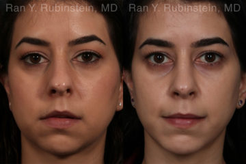 Chin Augmentation Before and After Photos in Montvale, NJ, Patient 12394
