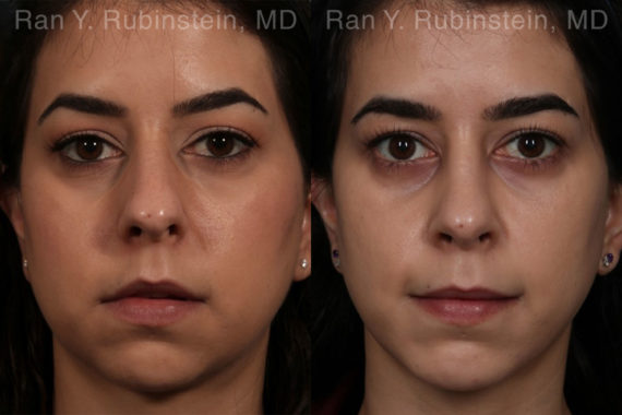 Chin Augmentation Before and After Photos in Montvale, NJ, Patient 12394