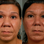 Chin Augmentation Before and After Photos in Montvale, NJ, Patient 12404