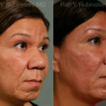Chin Augmentation Before and After Photos in Montvale, NJ, Patient 12404