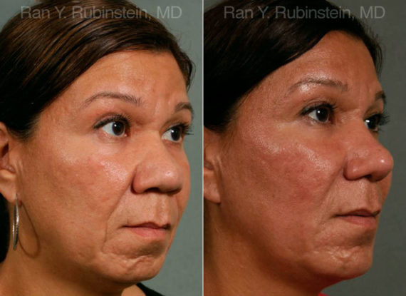 Chin Augmentation Before and After Photos in Montvale, NJ, Patient 12404