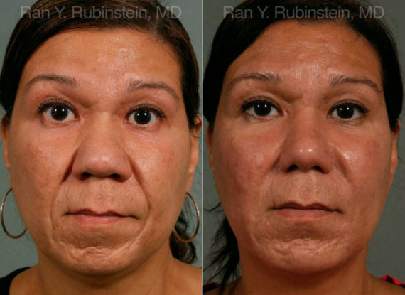 Ethnic Rhinoplasty Before and After Photos in Montvale, NJ, Patient 12533