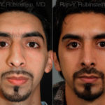 Ethnic Rhinoplasty Before and After Photos in Montvale, NJ, Patient 12558