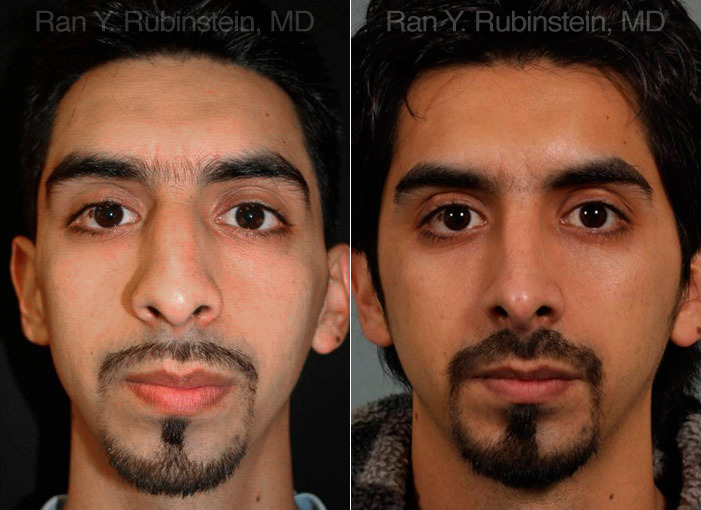 Ethnic Rhinoplasty Before and After Photos in Montvale, NJ, Patient 12558