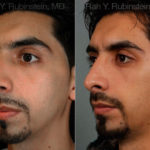Ethnic Rhinoplasty Before and After Photos in Montvale, NJ, Patient 12558