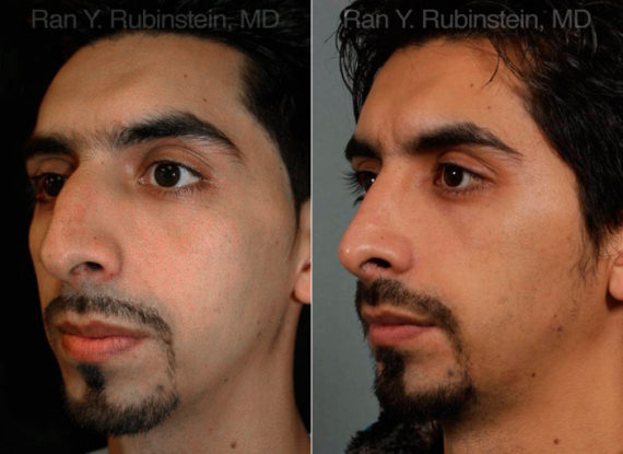 Ethnic Rhinoplasty Before and After Photos in Montvale, NJ, Patient 12558