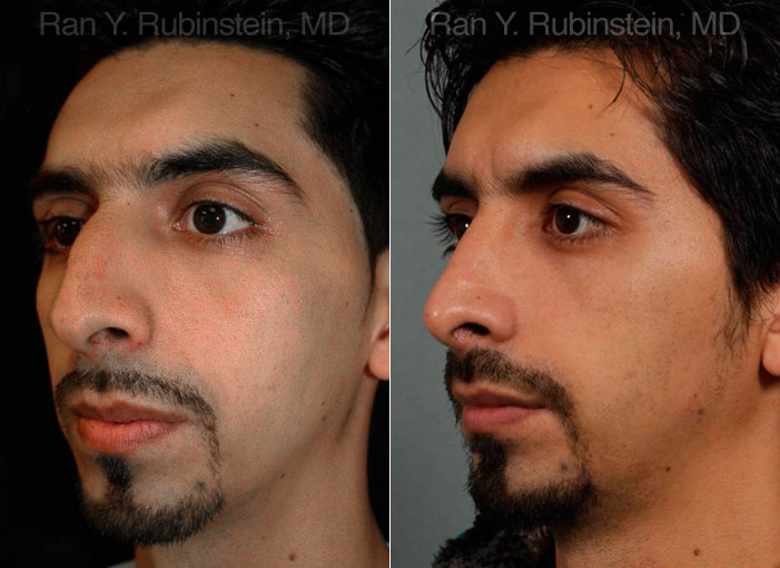 Ethnic Rhinoplasty Before and After Photos in Montvale, NJ, Patient 12558
