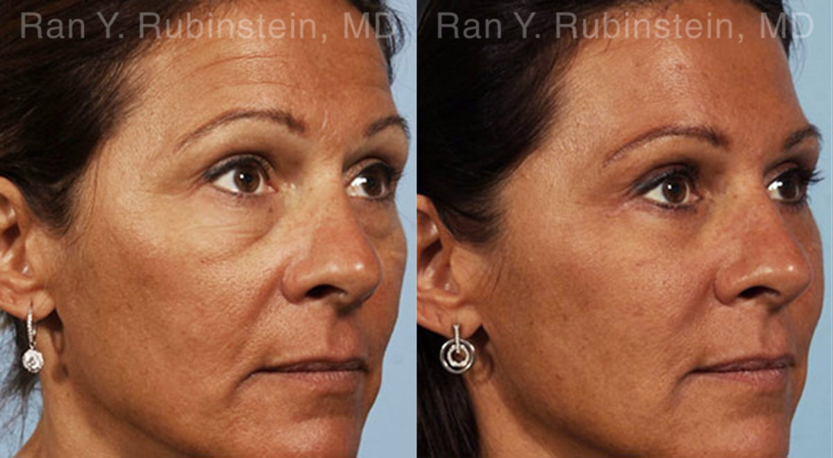 Eyelid Surgery Before and After Photos in Montvale, NJ, Patient 12586