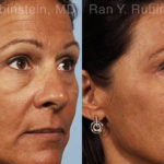 Eyelid Surgery Before and After Photos in Montvale, NJ, Patient 12586