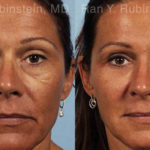 Eyelid Surgery Before and After Photos in Montvale, NJ, Patient 12586