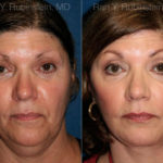 Face lift & Neck lift Before and After Photos in Montvale, NJ, Patient 12629