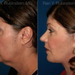 Face lift & Neck lift Before and After Photos in Montvale, NJ, Patient 12629