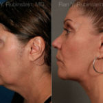 Face lift & Neck lift Before and After Photos in Montvale, NJ, Patient 12629