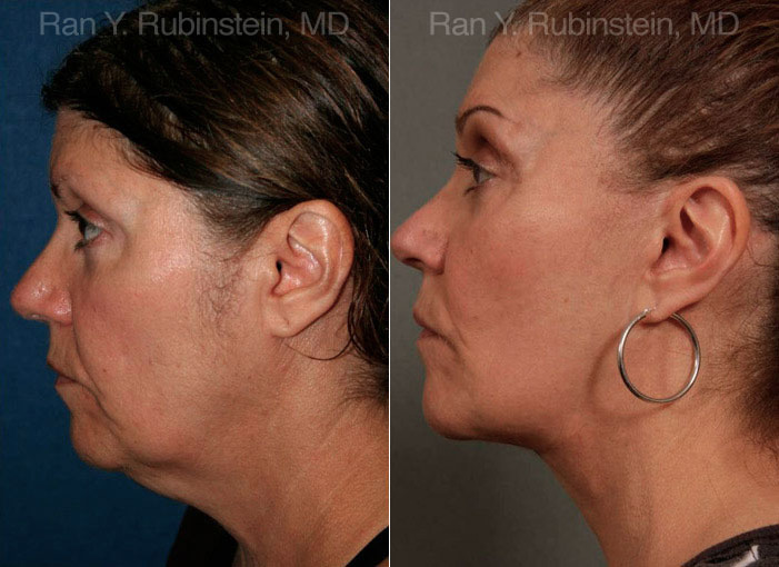 Face lift & Neck lift Before and After Photos in Montvale, NJ, Patient 12629
