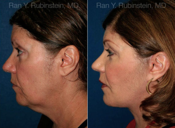 Face lift & Neck lift Before and After Photos in Montvale, NJ, Patient 12629