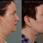 Face lift & Neck lift Before and After Photos in Montvale, NJ, Patient 12636
