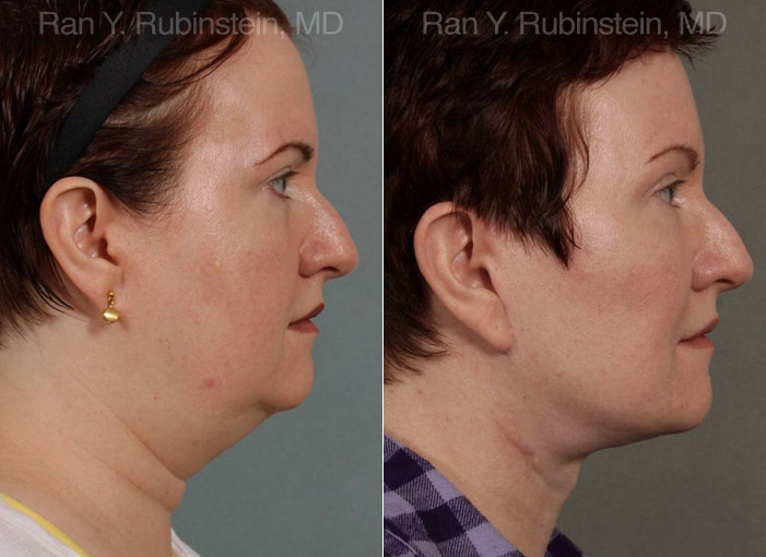 Face lift & Neck lift Before and After Photos in Montvale, NJ, Patient 12636