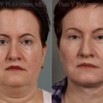 Face lift & Neck lift Before and After Photos in Montvale, NJ, Patient 12636